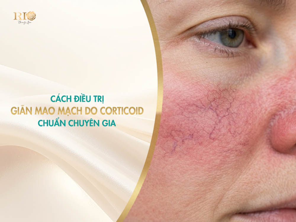 Vùng má nổi mảng đỏ và mạch máu li ti cần điều trị giãn mao mạch do corticoid chuẩn chuyên gia