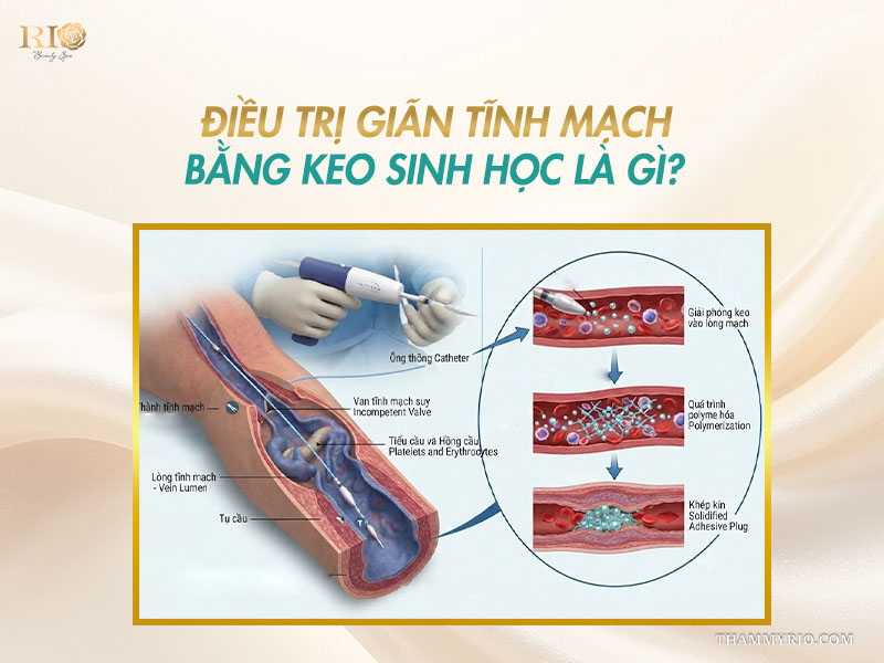 Hình ảnh mô phỏng y khoa quá trình điều trị giãn tĩnh mạch bằng keo sinh học bên trong lòng mạch.