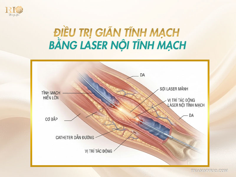 Sơ đồ luồn ống thông và sợi laser phát nhiệt trong phương pháp điều trị giãn tĩnh mạch không phẫu thuật bằng laser nội mạch