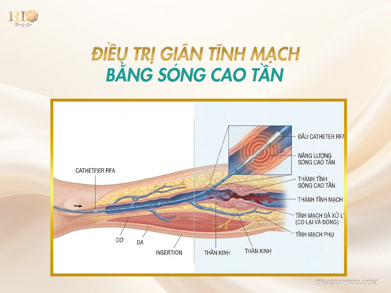 Sơ đồ kỹ thuật sóng cao tần RFA hỗ trợ điều trị giãn tĩnh mạch không phẫu thuật làm xẹp nhánh tĩnh mạch tổn thương