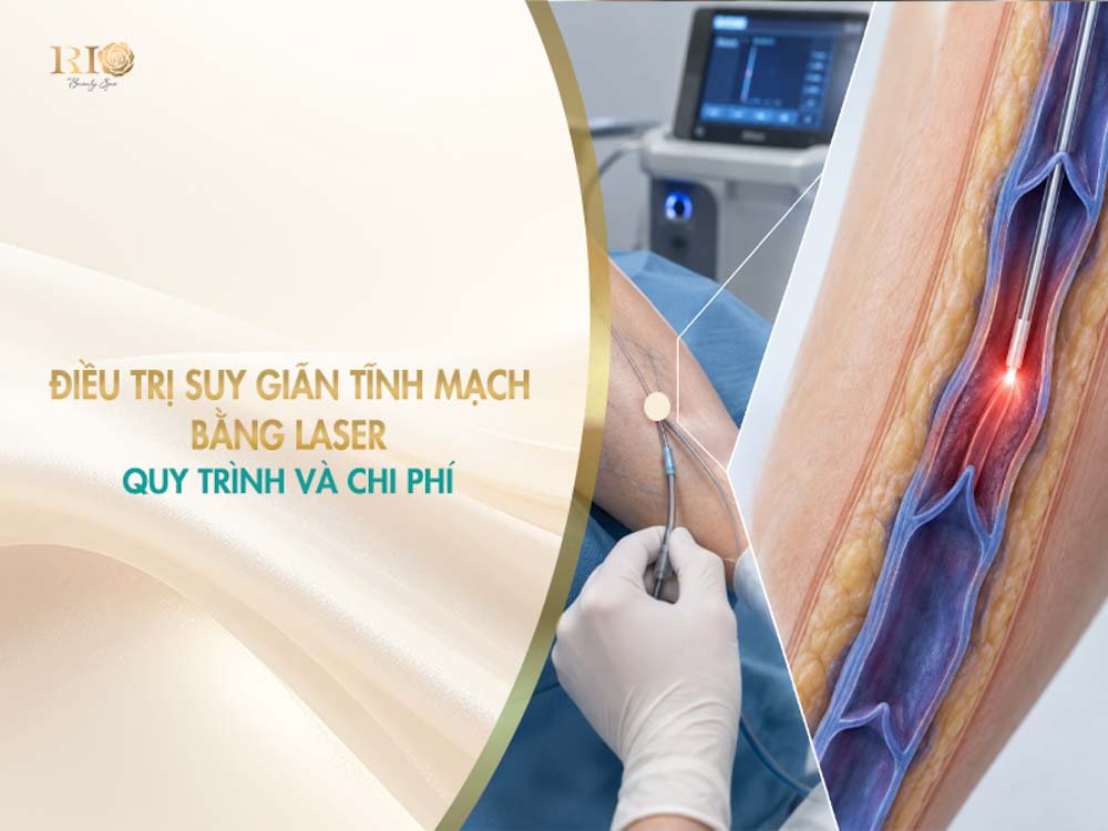 Mô phỏng cơ chế luồn sợi quang điều trị suy giãn tĩnh mạch bằng laser làm teo xơ mạch máu