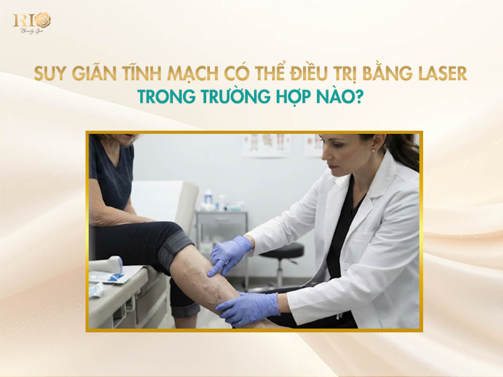 Chuyên viên kiểm tra các búi gân xanh ngoằn ngoèo trước khi điều trị suy giãn tĩnh mạch bằng laser