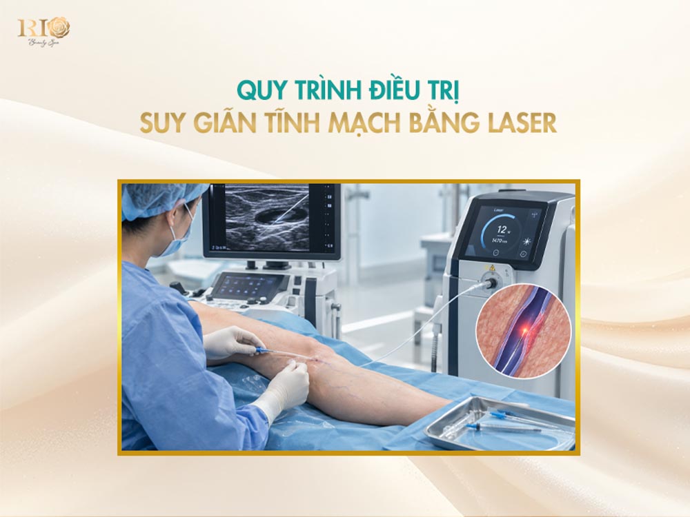Quy trình điều trị suy giãn tĩnh mạch bằng laser nội mạch dưới sự hỗ trợ của máy siêu âm