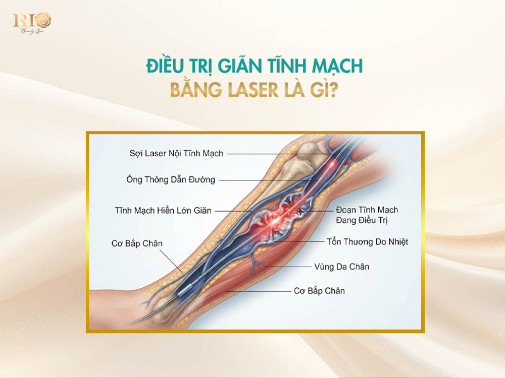 Sơ đồ nguyên lý phát nhiệt gây co mạch trong điều trị suy giãn tĩnh mạch bằng laser