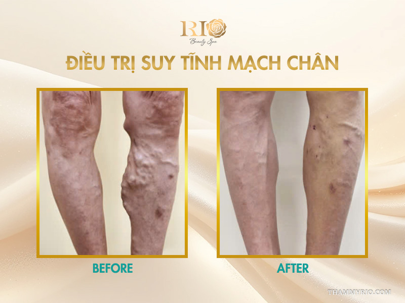 Kết quả trước và sau khi điều trị suy tĩnh mạch chân loại bỏ các búi gân ngoằn ngoèo gồ ghề