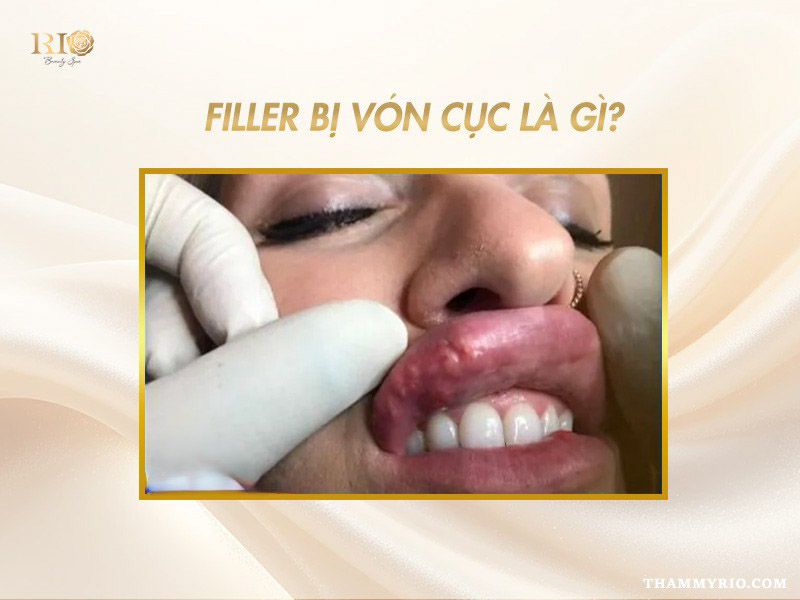Cận cảnh vùng môi xuất hiện các hạt sần sùi do filler bị vón cục.