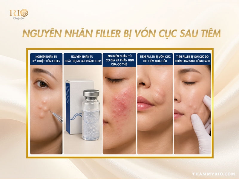 Sơ đồ tổng hợp 5 nguyên nhân chính khiến filler bị vón cục sau tiêm.