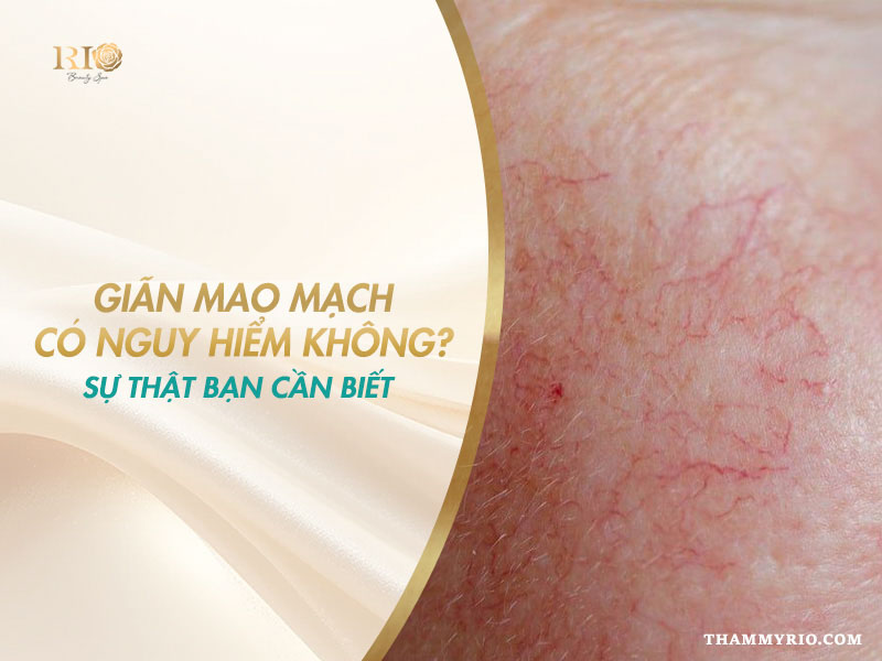 Giải đáp thắc mắc giãn mao mạch có nguy hiểm không và sự thật cần biết.