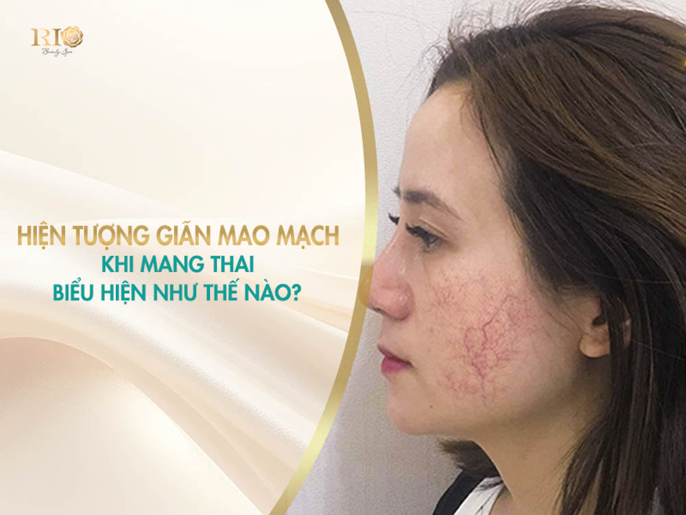 Vùng má nổi mạng lưới tia máu đỏ hình mạng nhện do giãn mao mạch khi mang thai