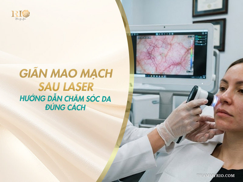 Giãn mao mạch sau laser: hướng dẫn chăm sóc da đúng cách
