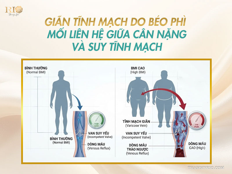 Giãn tĩnh mạch do béo phì mối liên hệ giữa cân nặng và suy tĩnh mạch.