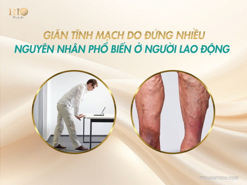Giãn tĩnh mạch do đứng nhiều nguyên nhân phổ biến ở người lao động.