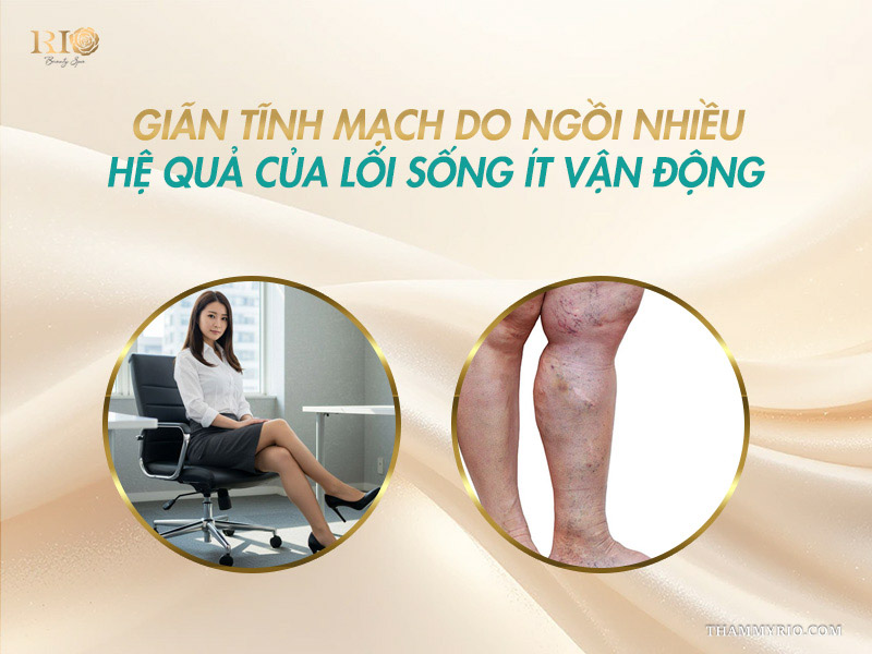Giãn tĩnh mạch do ngồi nhiều hệ quả của lối sống ít vận động.