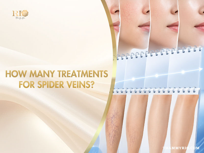Progressive timeline showing how many treatments for spider veins on facial and leg areas