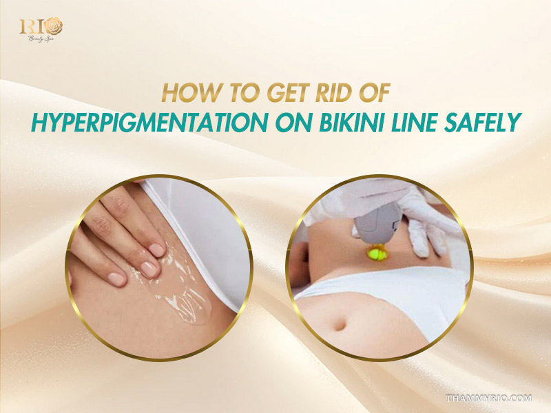 Dual circular comparison of soothing gel application and laser therapy for hyperpigmentation bikini line treatment