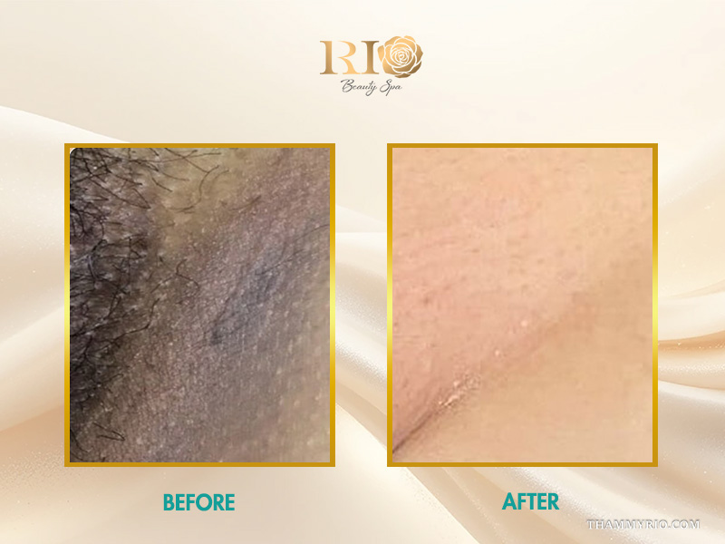 Before and after clinical result showing visible skin lightening from hyperpigmentation bikini line treatment