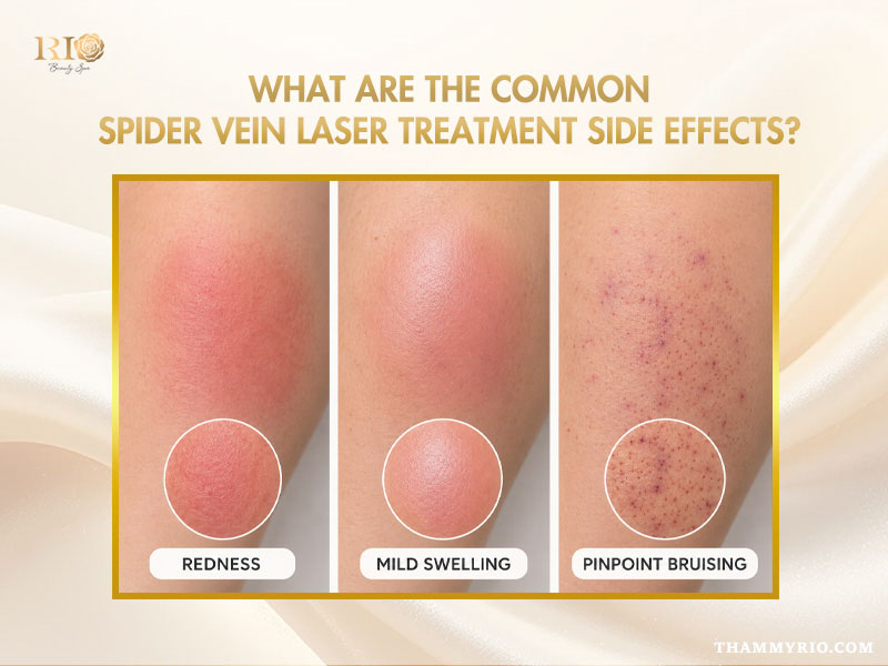Common spider vein laser treatment side effects including redness, swelling, and bruising