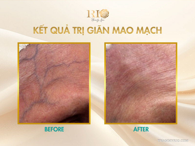 Kết quả trị giãn mao mạch triệt tiêu các búi tĩnh mạch và mao mạch xanh tím nổi gồ