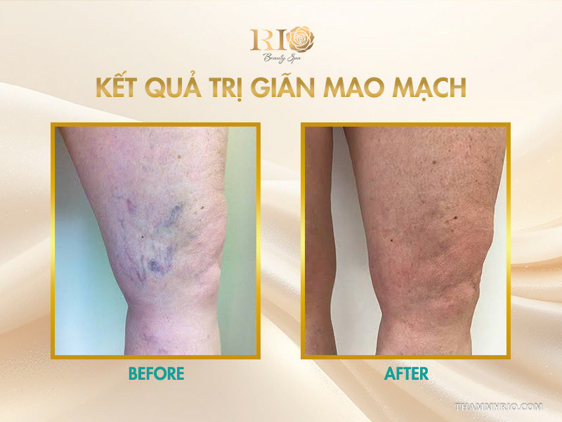 Kết quả trị giãn mao mạch làm mờ các đám mạch máu tím sẫm ở bắp chân và sau gối