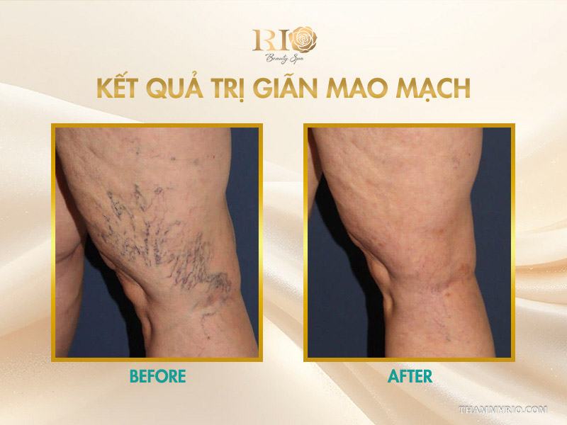 Trước và sau khi trị liệu ghi nhận kết quả trị giãn mao mạch triệt tiêu chùm mạch máu dạng rễ cây ở đùi