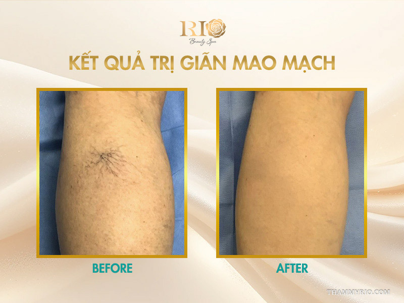 Búi mao mạch hình mạng nhện ở bắp chân biến mất hoàn toàn nhờ kết quả trị giãn mao mạch