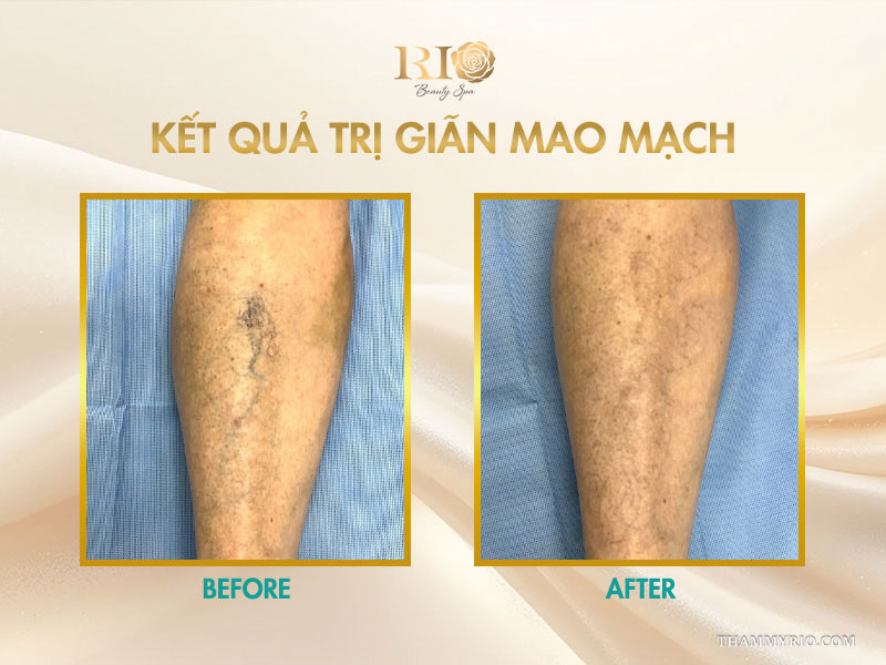 Kết quả trị giãn mao mạch xóa bỏ đường gân mạch máu ngoằn ngoèo dọc bắp chuối chân