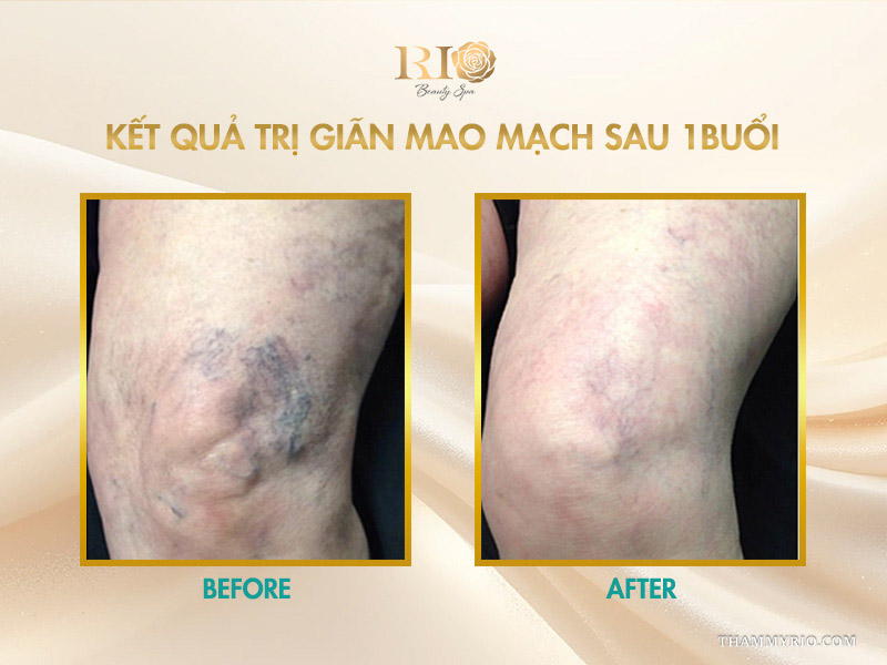 Kết quả trị giãn mao mạch sau 1 buổi làm mờ nhanh các chùm mạch máu tím quanh khớp gối
