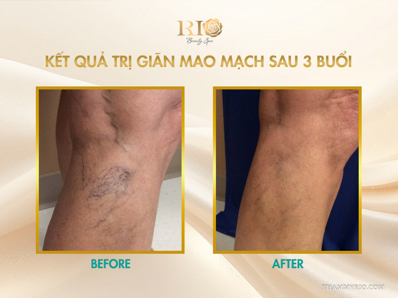 Mảng mao mạch mạng nhện co biến rõ rệt minh chứng kết quả trị giãn mao mạch sau 3 buổi