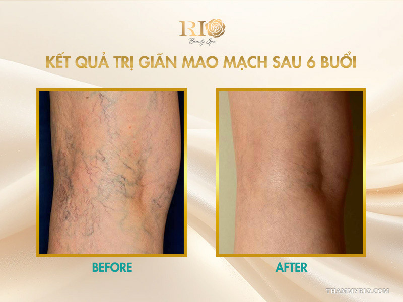 Toàn bộ búi mao mạch chằng chịt ở chân sạch bóng ghi nhận kết quả trị giãn mao mạch sau 6 buổi