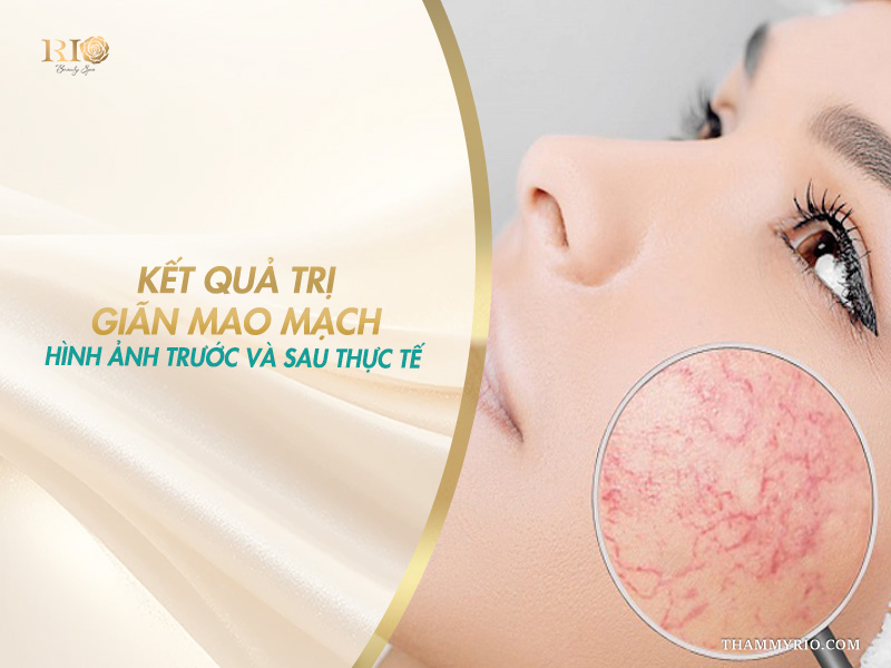 Kính lúp soi rõ mạng lưới mạch máu đỏ minh họa kết quả trị giãn mao mạch thực tế