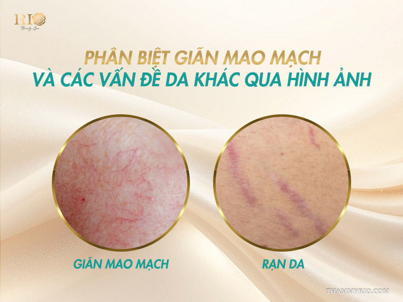 Phân biệt vùng da giãn mao mạch và rạn da trước khi xem kết quả trị giãn mao mạch