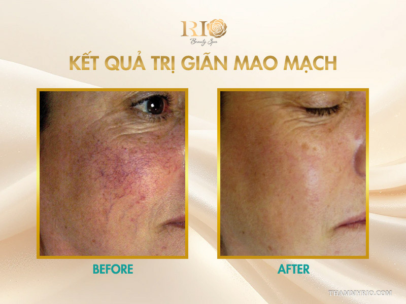 Kết quả trị giãn mao mạch xóa sạch mảng đỏ và gân máu ở gò má khách hàng lớn tuổi