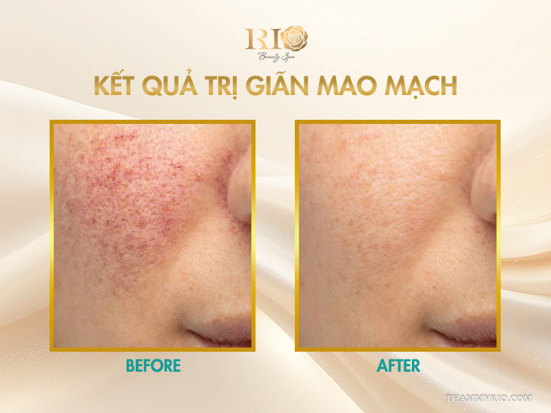 Vùng má ửng đỏ chấm dứt hoàn toàn sau khi nhận kết quả trị giãn mao mạch thành công