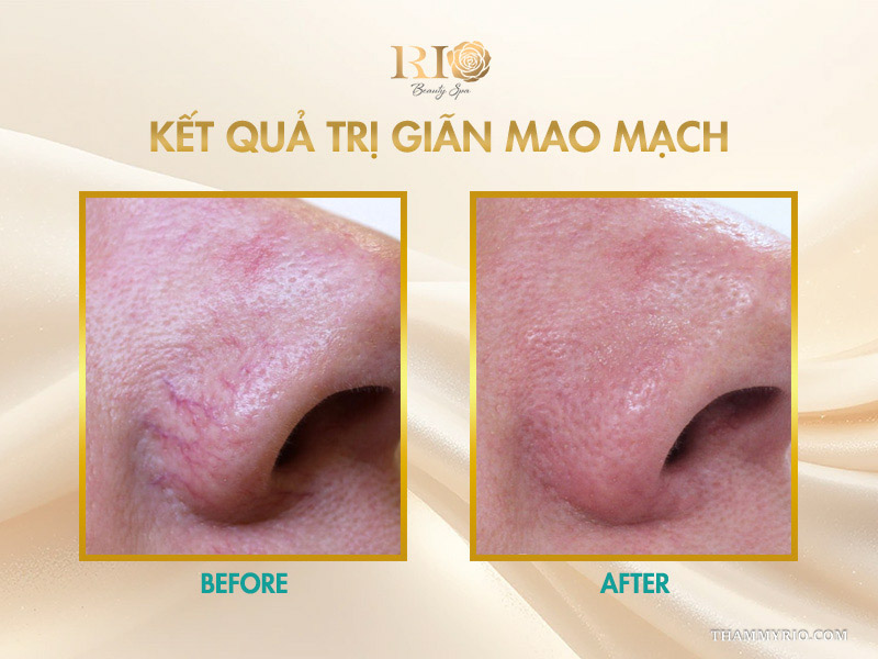 Mạng lưới mạch máu mạng nhện ở cánh mũi nam giới biến mất nhờ kết quả trị giãn mao mạch