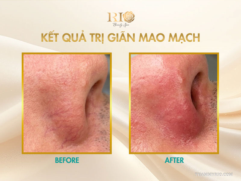 Kết quả trị giãn mao mạch làm mờ các tia máu đỏ tím quanh rãnh cánh mũi