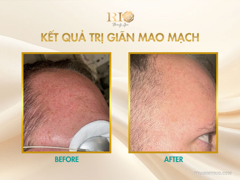 Trước và sau khi trị liệu vùng trán ghi nhận kết quả trị giãn mao mạch phẳng mịn, đều màu