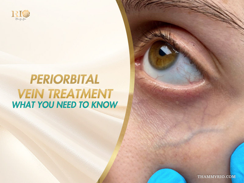 Close-up of prominent blue under-eye veins being examined on a banner introducing what you need to know about periorbital vein treatment