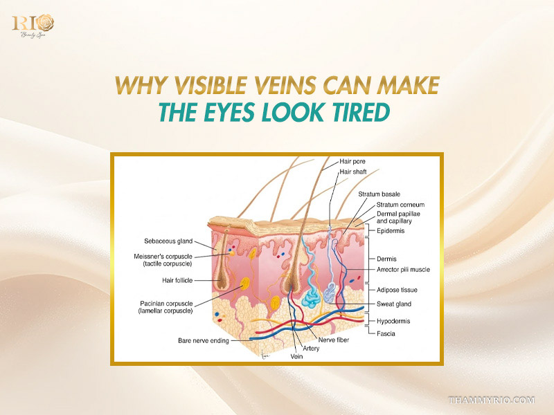 Cross-section diagram of skin layers showing superficial vascular networks explaining the need for periorbital vein treatment