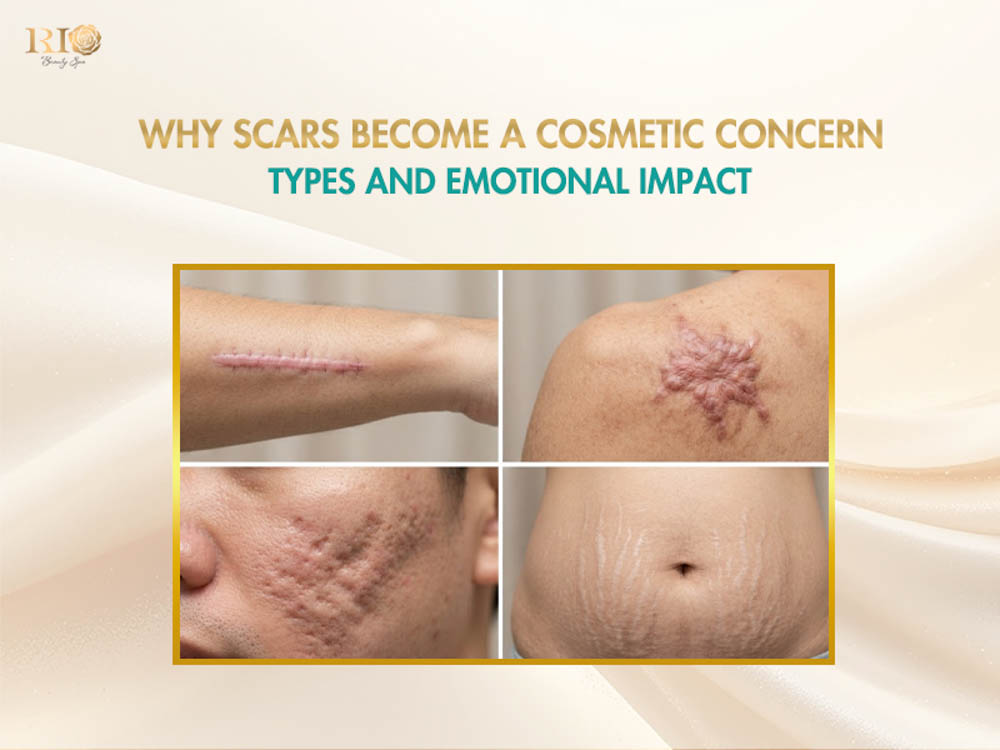 Four types of common scar formations suitable for scar camouflage tattoo treatments