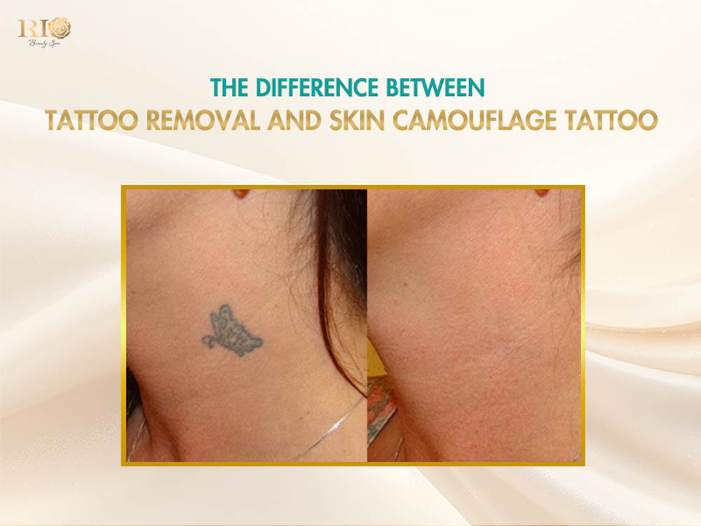 Before and after comparison of crown tattoo clearance on the neck using skin tone tattoo cover up