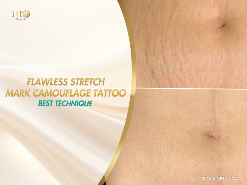 Flawless stretch mark camouflage tattoo best technique on stomach skin