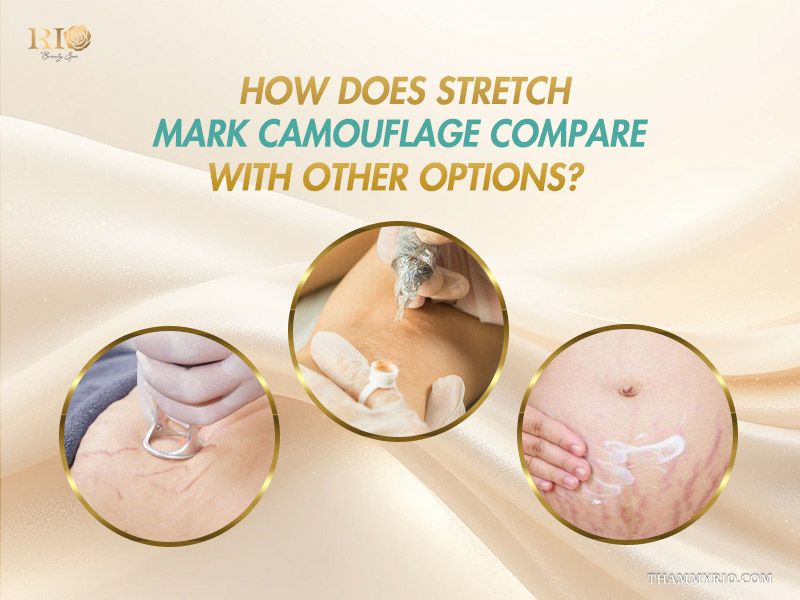 Comparing stretch mark camouflage tattoo with laser and topical treatment options