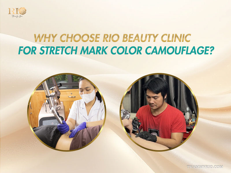 Rio Beauty Clinic specialist performing stretch mark camouflage tattoo treatment