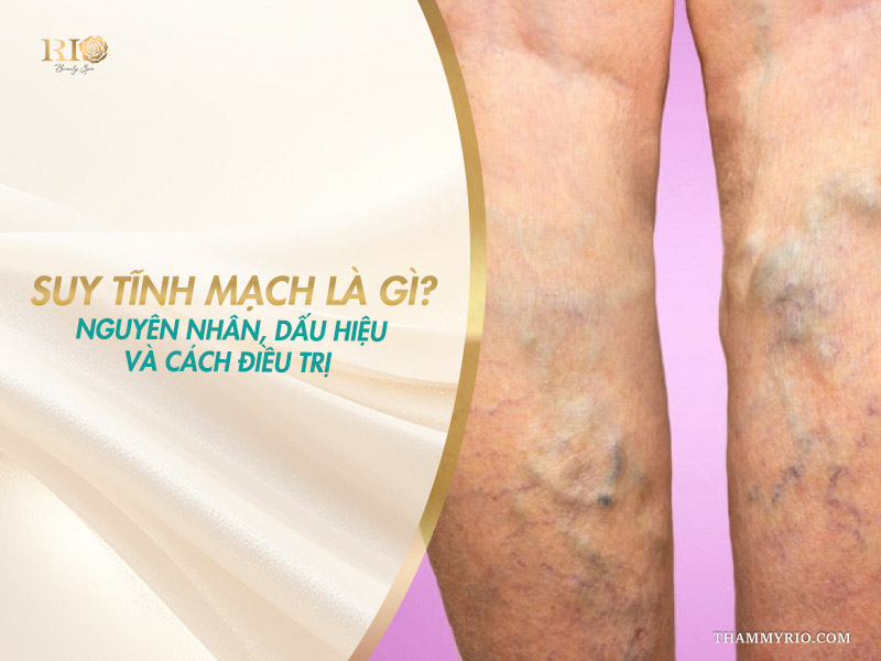 Đôi chân nổi búi gân xanh tím minh họa khái niệm suy tĩnh mạch là gì cùng nguyên nhân và cách điều trị