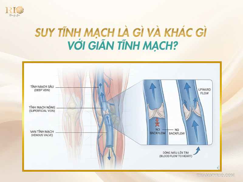 Sơ đồ giải phẫu van mạch máu và dòng chảy ngược giải thích cơ chế suy tĩnh mạch là gì