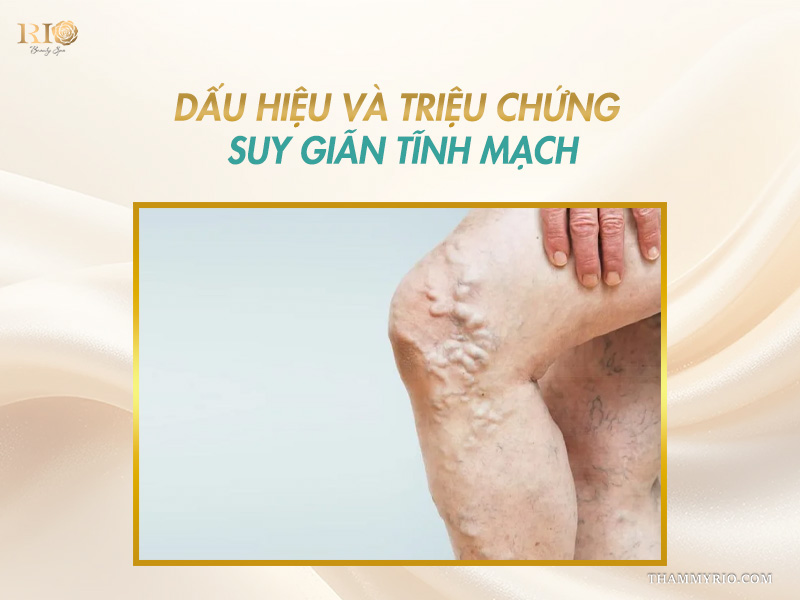 Búi tĩnh mạch ngoằn ngoèo nổi cộm ở đầu gối là dấu hiệu nhận biết suy tĩnh mạch là gì