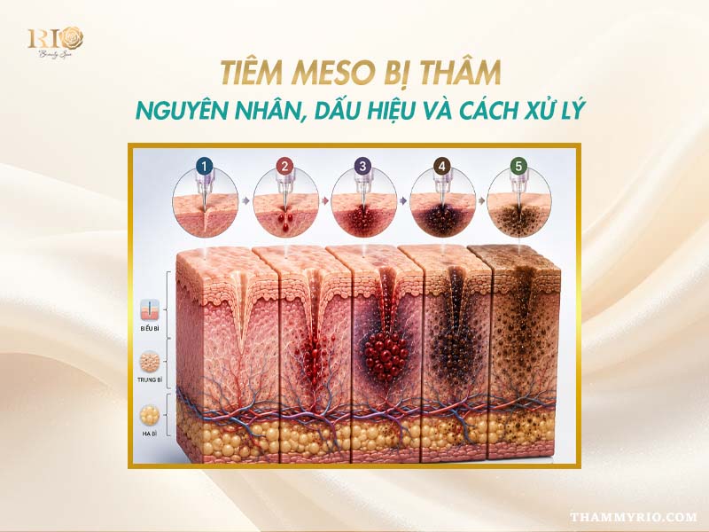 Sơ đồ giải phẫu năm giai đoạn hình thành vết thâm là tác hại của tiêm meso.