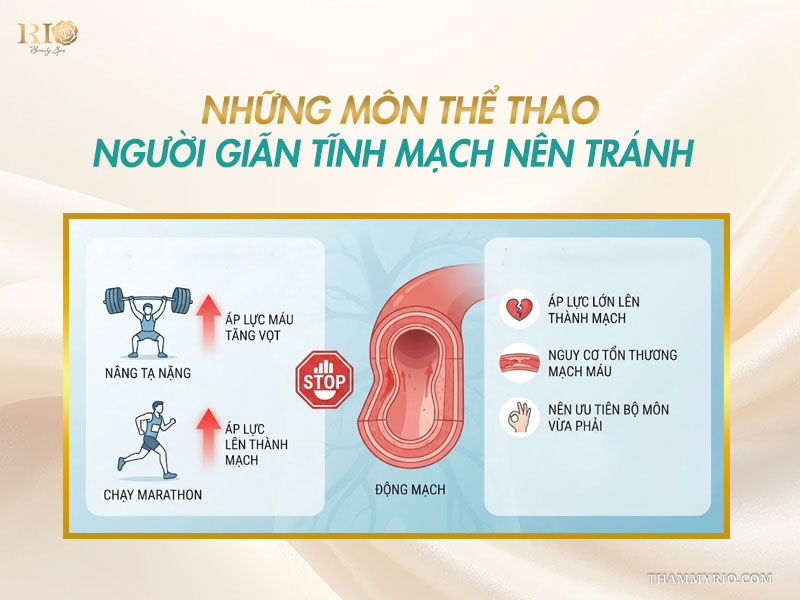 Những môn thể thao cần tránh khi áp dụng tập thể dục cho người giãn tĩnh mạch.
