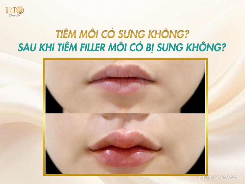 So sánh hình ảnh trước và sau khi khách hàng gặp tình trạng tiêm môi bị sưng.