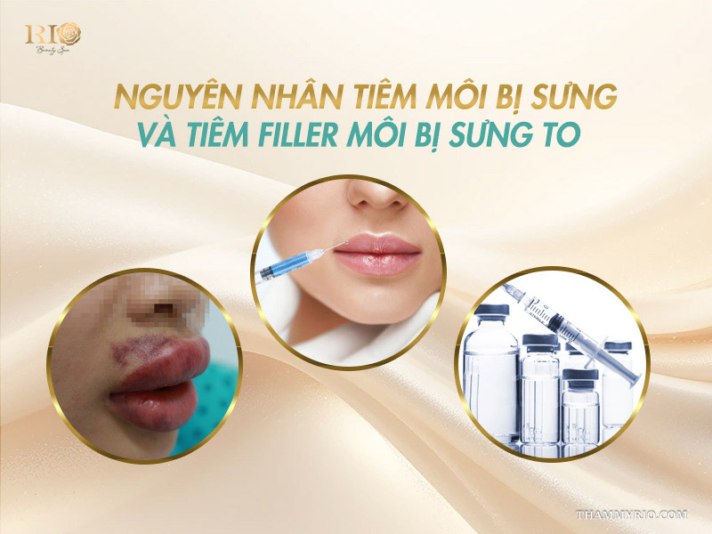 Phân tích các nguyên nhân phổ biến khiến tiêm môi bị sưng to bất thường.